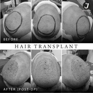 รีวิวปลูกผม FUE