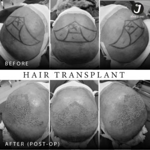 รีวิวปลูกผม FUE