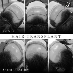 รีวิวปลูกผม FUE