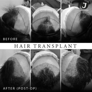รีวิวปลูกผม FUE