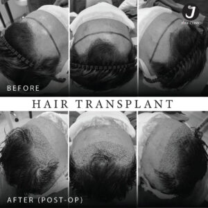 รีวิวปลูกผม FUE