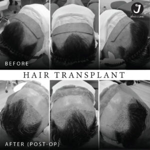 รีวิวปลูกผม FUE