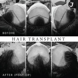 รีวิวปลูกผม FUE