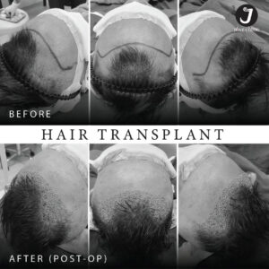 รีวิวปลูกผม FUE