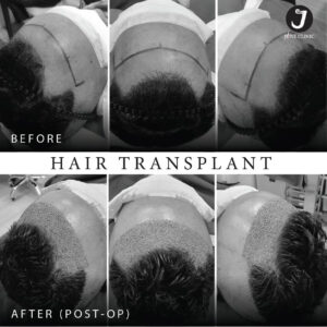 รีวิวปลูกผม FUE