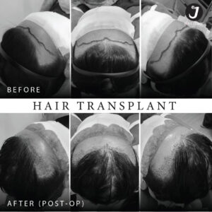 รีวิวปลูกผม FUE