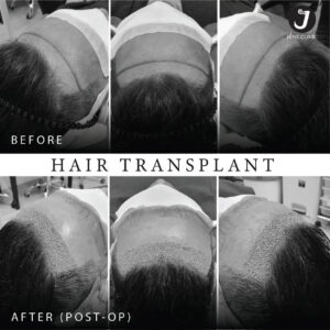 รีวิวปลูกผม FUE