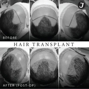 รีวิวปลูกผม FUE