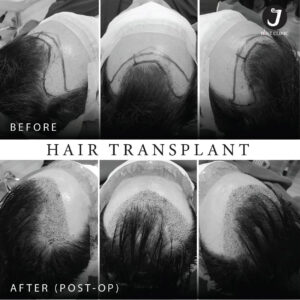 รีวิวปลูกผม FUE