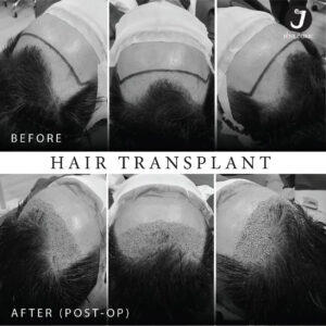 รีวิวปลูกผม