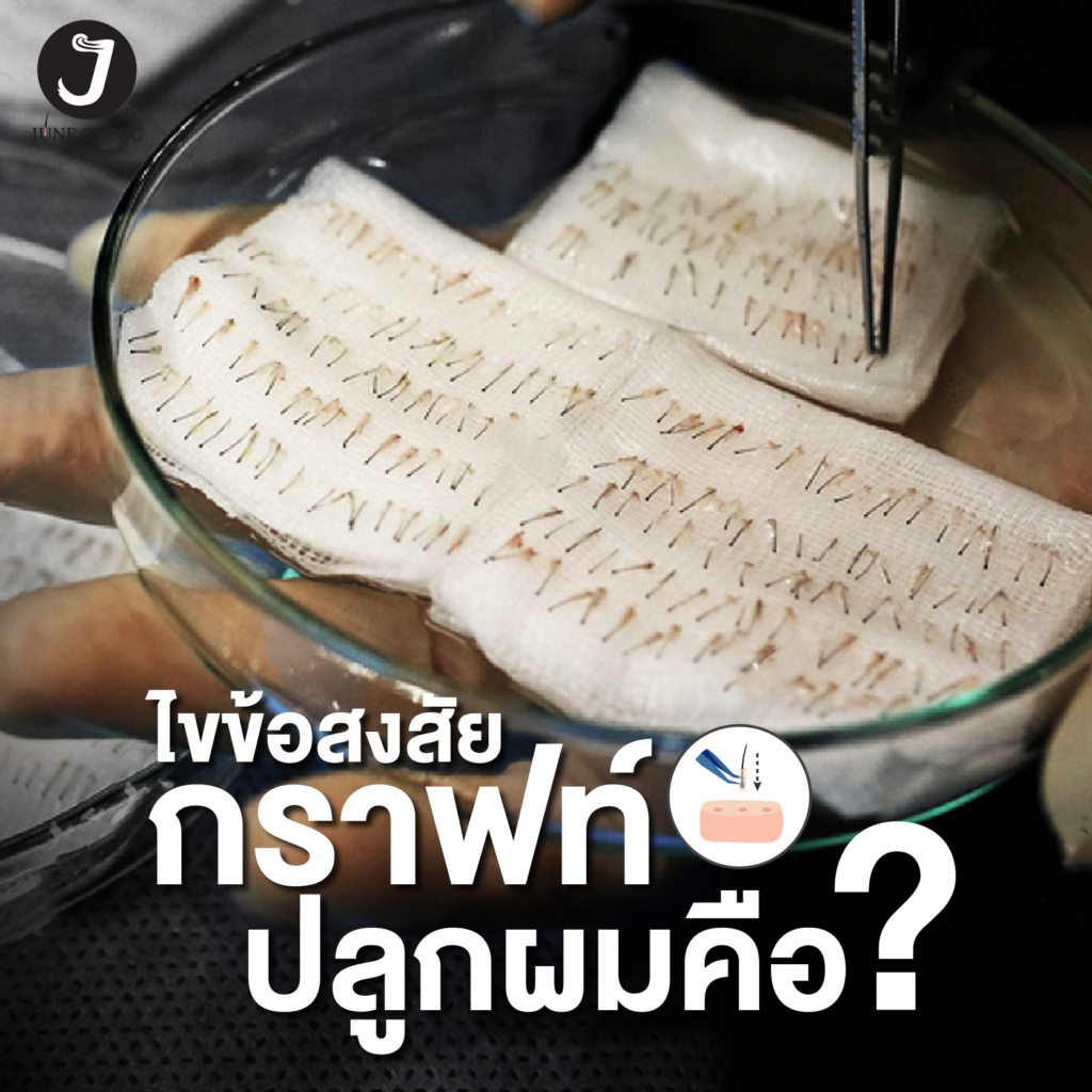 กราฟผมคืออะไร