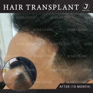รีวิวปลูกผม10เดือน