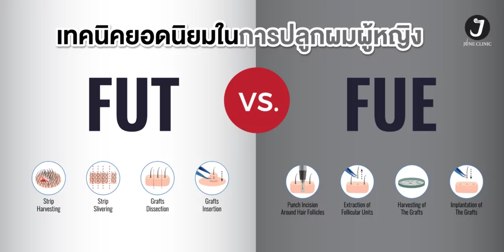 เทคนิคยอดนิยมในการปลูกผม
