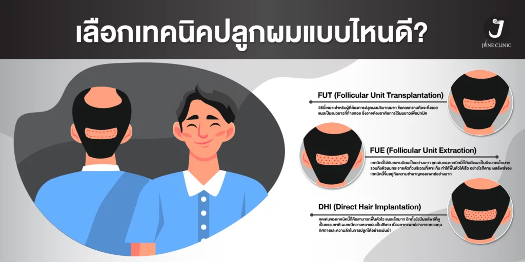เทคนิคการปลูกผม