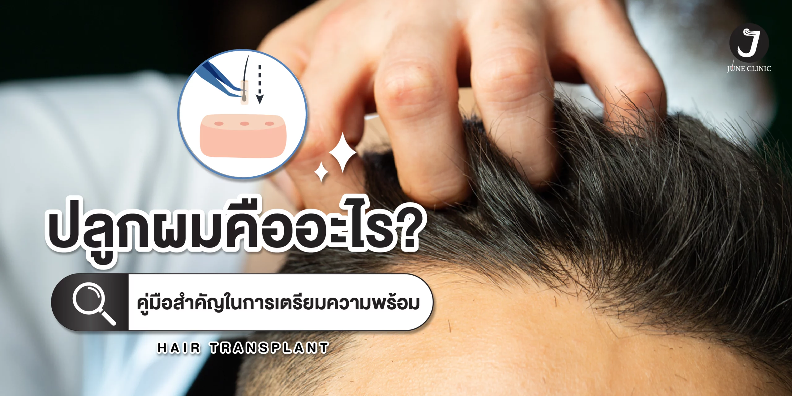 ปลูกผมคืออะไร