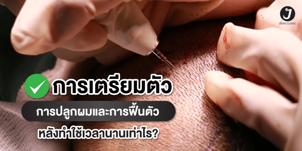 การเตรียมตัวปลูกผม