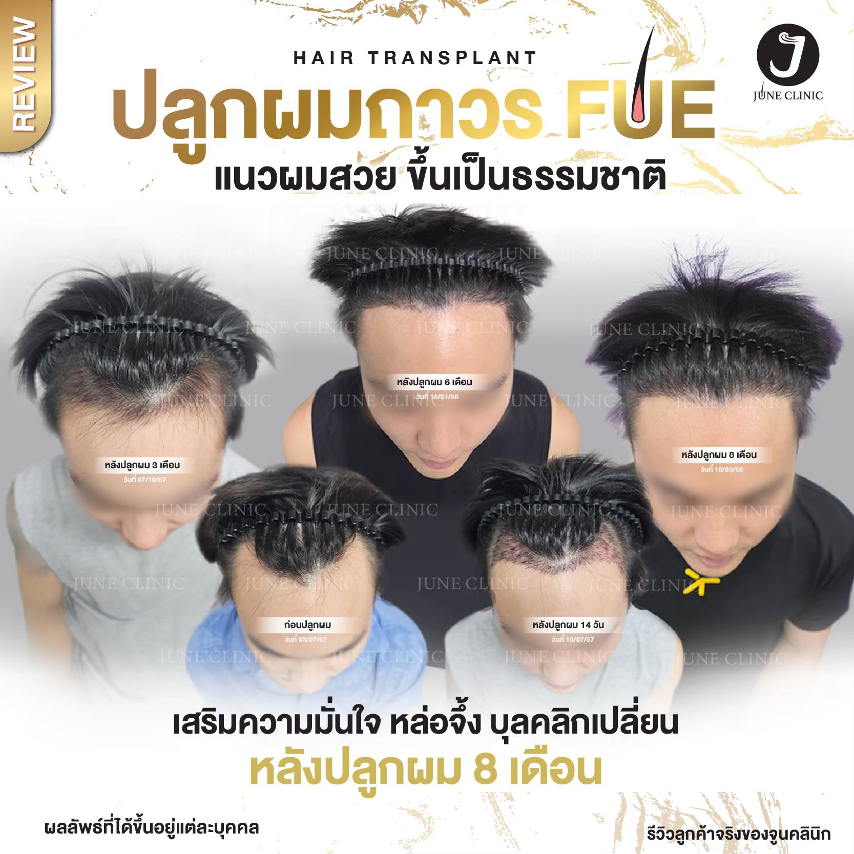 รีวิวปลูกผม 10