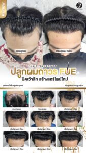 รีวิวปลูกผม 11