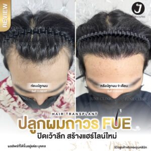 รีวิวปลูกผม 12