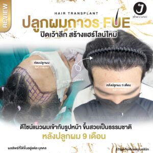 รีวิวปลูกผม 13