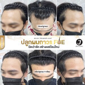 รีวิวปลูกผม 14