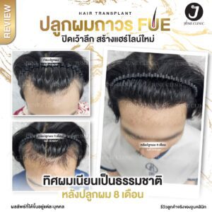 รีวิวปลูกผม 15