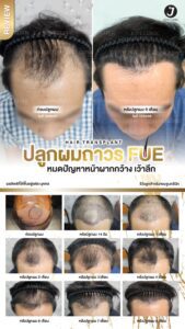 รีวิวปลูกผม 16