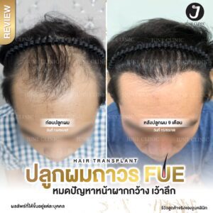 รีวิวปลูกผม 17