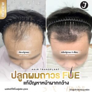 รีวิวปลูกผม 18