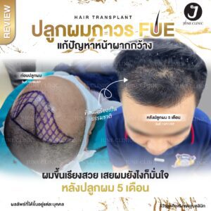 รีวิวปลูกผม 19