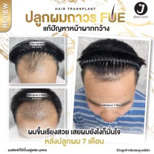 รีวิวปลูกผม 20
