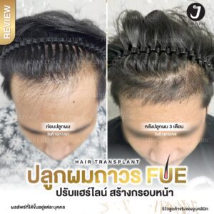รีวิวปลูกผม 24