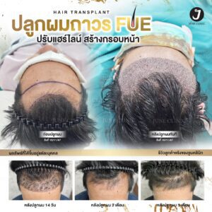 รีวิวปลูกผม 25
