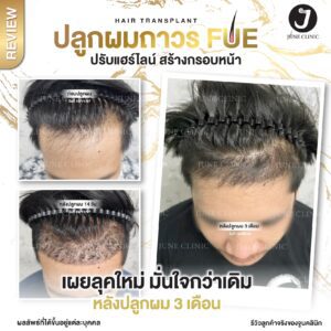 รีวิวปลูกผม 26