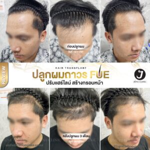รีวิวปลูกผม 27