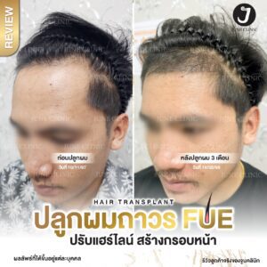 รีวิวปลูกผม 28