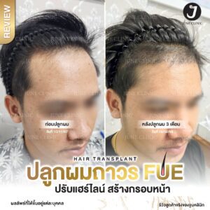 รีวิวปลูกผม 29
