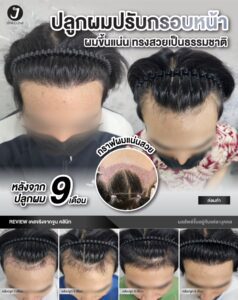 รีวิวปลูกผม 3