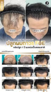 รีวิวปลูกผม 30