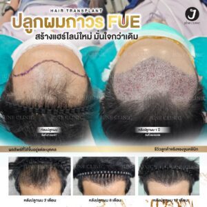 รีวิวปลูกผม 32