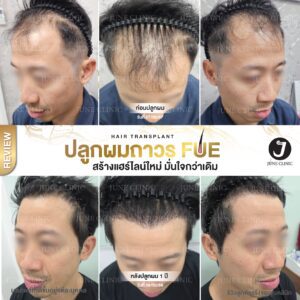 รีวิวปลูกผม 33