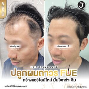 รีวิวปลูกผม 34