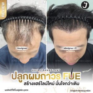 รีวิวปลูกผม 36