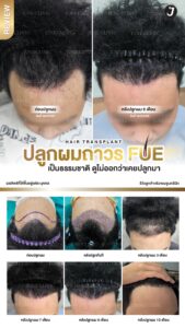 รีวิวปลูกผม 37