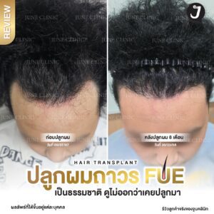 รีวิวปลูกผม 38