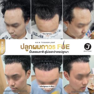 รีวิวปลูกผม 39