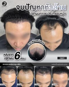 รีวิวปลูกผม 4
