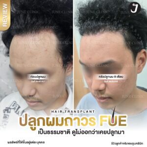 รีวิวปลูกผม 40