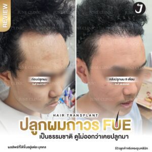 รีวิวปลูกผม 41