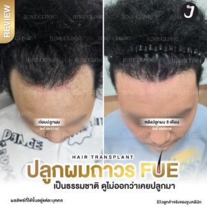 รีวิวปลูกผม 42